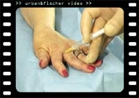 Ozon in der Schmerztherapie, 1 Videocassette - Alexander Balkanyi