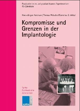 Kompromisse und Grenzen in der Implantologie