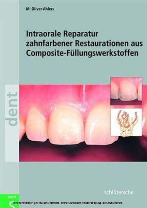 Intraorale Reparatur zahnfarbener Restaurationen aus Composite-Füllungswerkstoffen