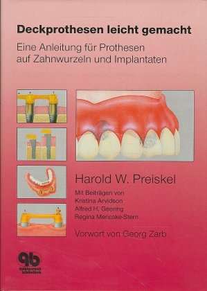 Deckprothesen leicht gemacht