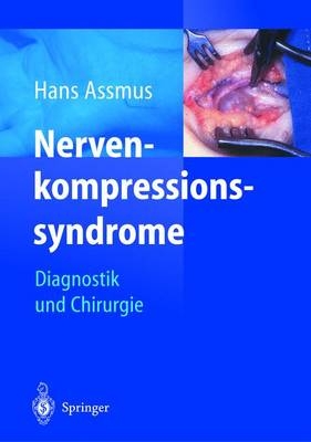 Nervenkompressionssyndrome