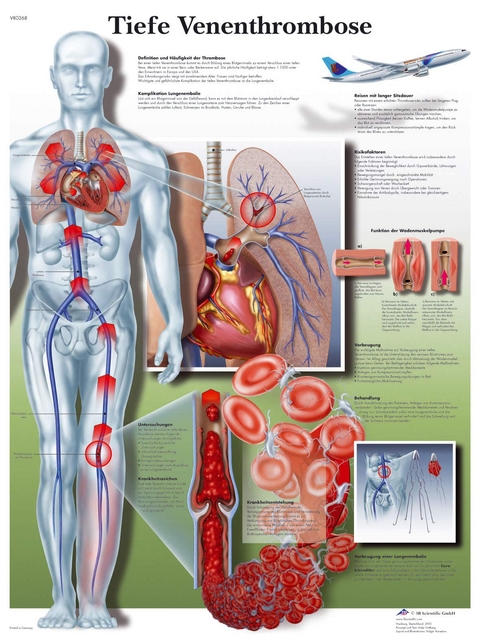 Tiefe Venenthrombose
