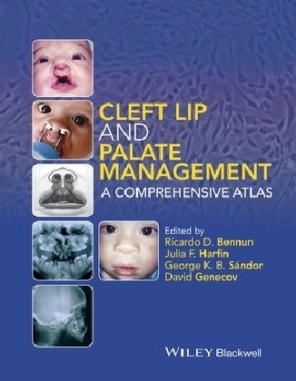 Cleft Lip and Palate Management - David Genecov, George K. B. Sandor