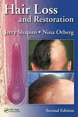 Hair Loss and Restoration - 