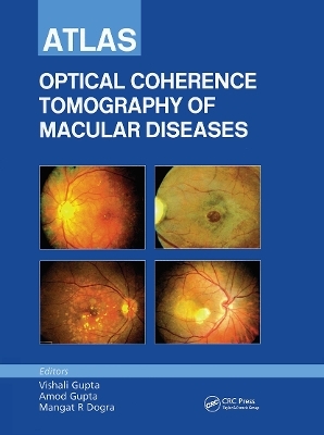 Atlas of Optical Coherence Tomography of Macular Diseases