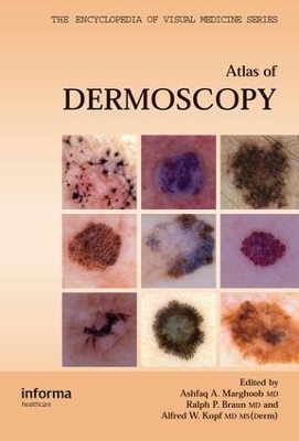 An Atlas of Dermoscopy