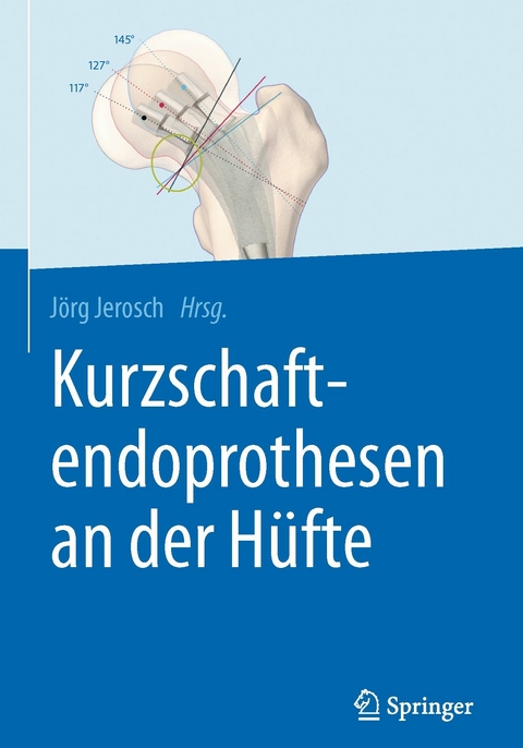 Kurzschaftendoprothesen an der H&uuml;fte - 