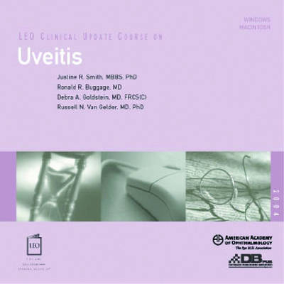 Uveitis