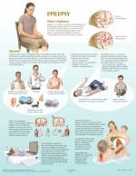 Epilepsy Chart