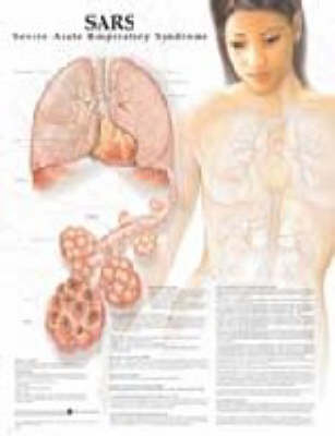 SARS