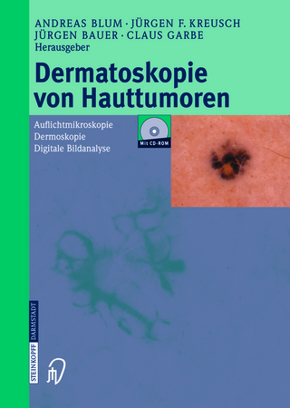 Dermatoskopie von Hauttumoren