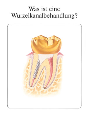 Was ist eine Wurzelkanalbehandlung?