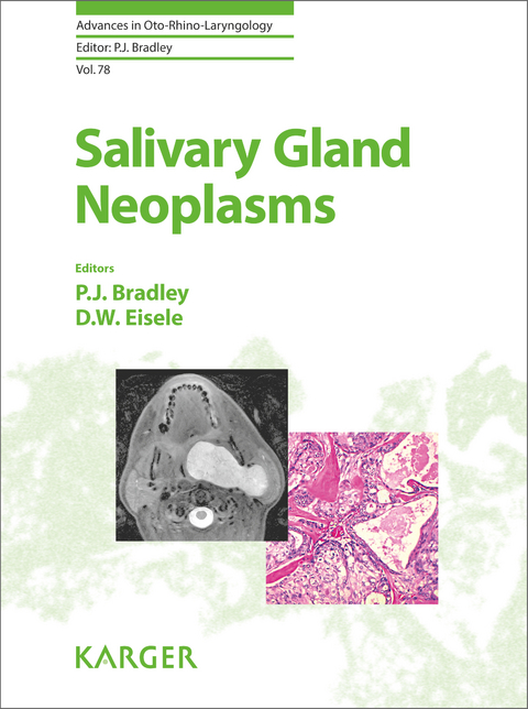 Salivary Gland Neoplasms - 