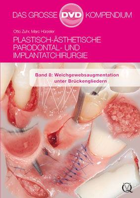 Plastisch-&Auml;sthetische Parodontal- und Implantatchirurgie / Plastisch-&Auml;sthetische Parodontal- und Implantatchirurgie - Otto Zuhr, Marc H&uuml;rzeler