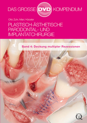 Plastisch-Ästhetische Parodontal- und Implantatchirurgie