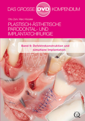 Plastisch-&Auml;sthetische Parodontal- und Implantatchirurgie - Otto Zuhr, Marc H&uuml;rzeler