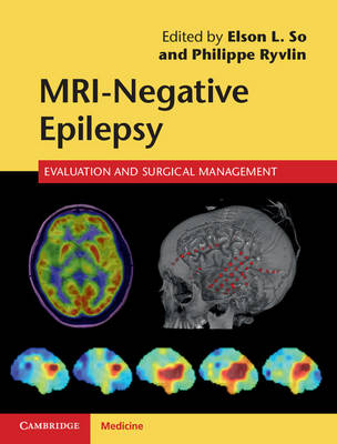 MRI - Negative Epilepsy