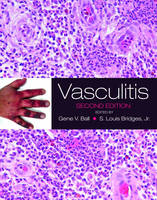 Vasculitis