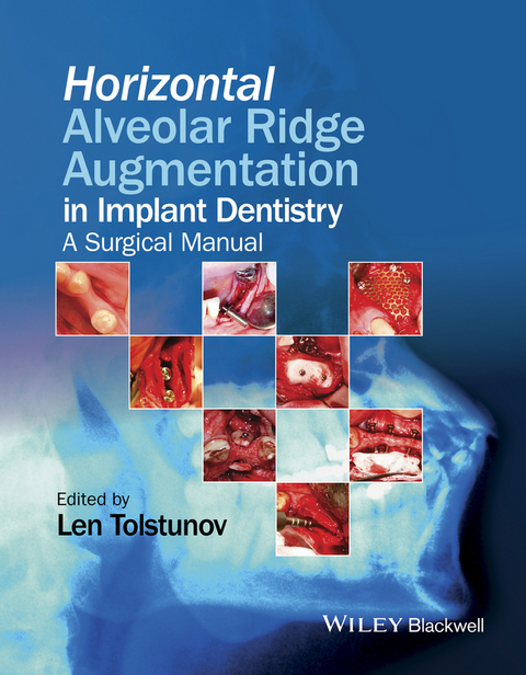 Horizontal Alveolar Ridge Augmentation in Implant Dentistry - Len Tolstunov