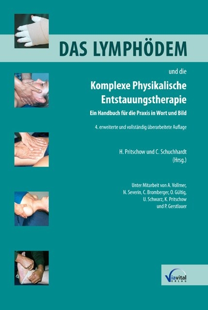 Das Lymph&ouml;dem und die Komplexe Physikalische Entstauungstherapie - 