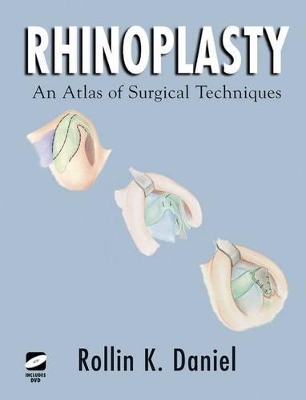 Rhinoplasty