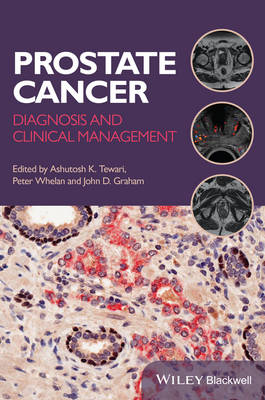 Prostate Cancer - Peter Whelan, Ashutosh K. Tewari, John D. Graham