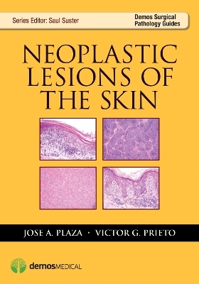 Neoplastic Lesions of the Skin