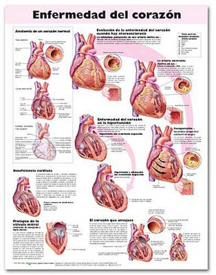 Heart Disease Anatomical Chart in Spanish (Enfermedad del coraz&oacute;n)