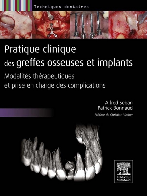 Pratique clinique des greffes osseuses et implants -  Patrick Bonnaud,  Alfred Seban