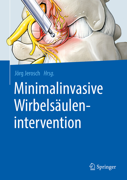 Minimalinvasive Wirbels&auml;ulenintervention - 