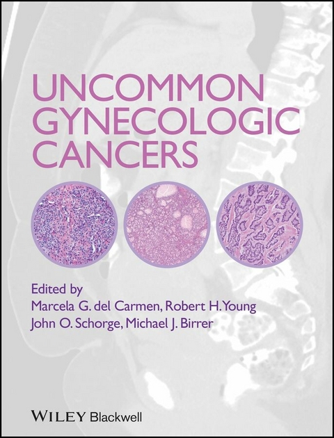 Uncommon Gynecologic Cancers - 