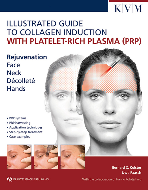 Illustrated Guide to Collagen Induction with Platelet-Rich Plasma (PRP) - Bernard Kolster, Uwe Paasch