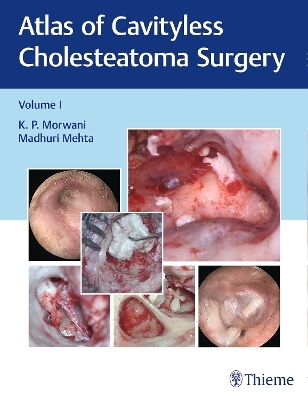 Atlas of Cavityless Cholesteatoma Surgery, Vol 1 - K Morwani, Madhuri Mehta