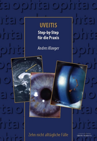 Uveitis