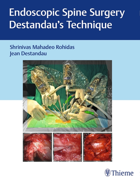 Endoscopic Spine Surgery - Shrinivas Mahadeo Rohidas