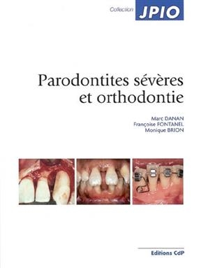 PARODONTITES SEVERES ET ORTHODONTIE