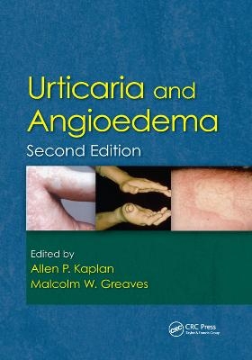 Urticaria and Angioedema - 