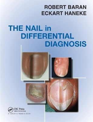 Nail in Differential Diagnosis - Robert Baran, Eckart Haneke