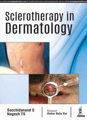 Sclerotherapy in Dermatology