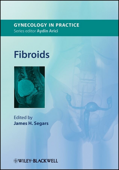 Fibroids - 