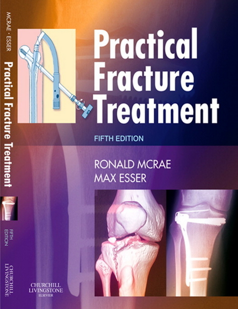 Practical Fracture Treatment E-Book -  Max Esser,  Ronald McRae
