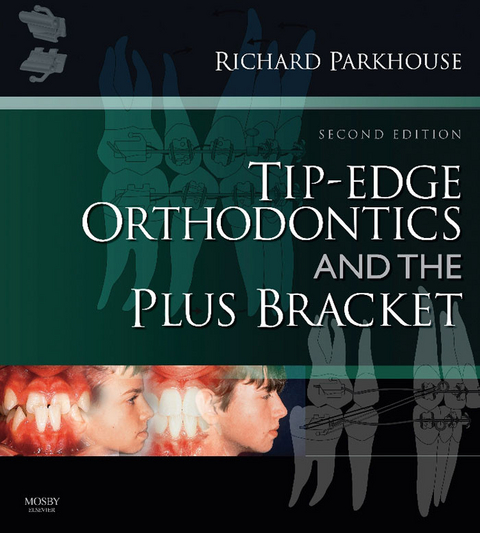 Tip-Edge Orthodontics and the Plus Bracket -  Richard Parkhouse