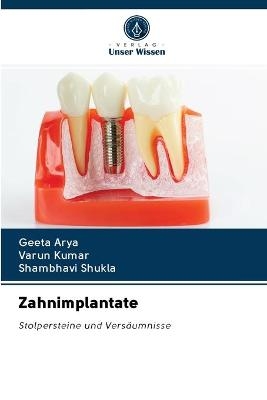 Zahnimplantate - Geeta Arya, Varun Kumar, Shambhavi Shukla