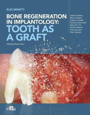 Bone regeneration in implantology - tooth as a graft