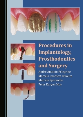 Procedures in Implantology, Prosthodontics and Surgery - Andr&eacute; Antonio Pelegrine, Marcelo Lucchesi Teixeira, Marcelo Sperandio